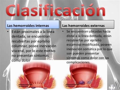 hemorroides externas fotos|Hemorroides externas